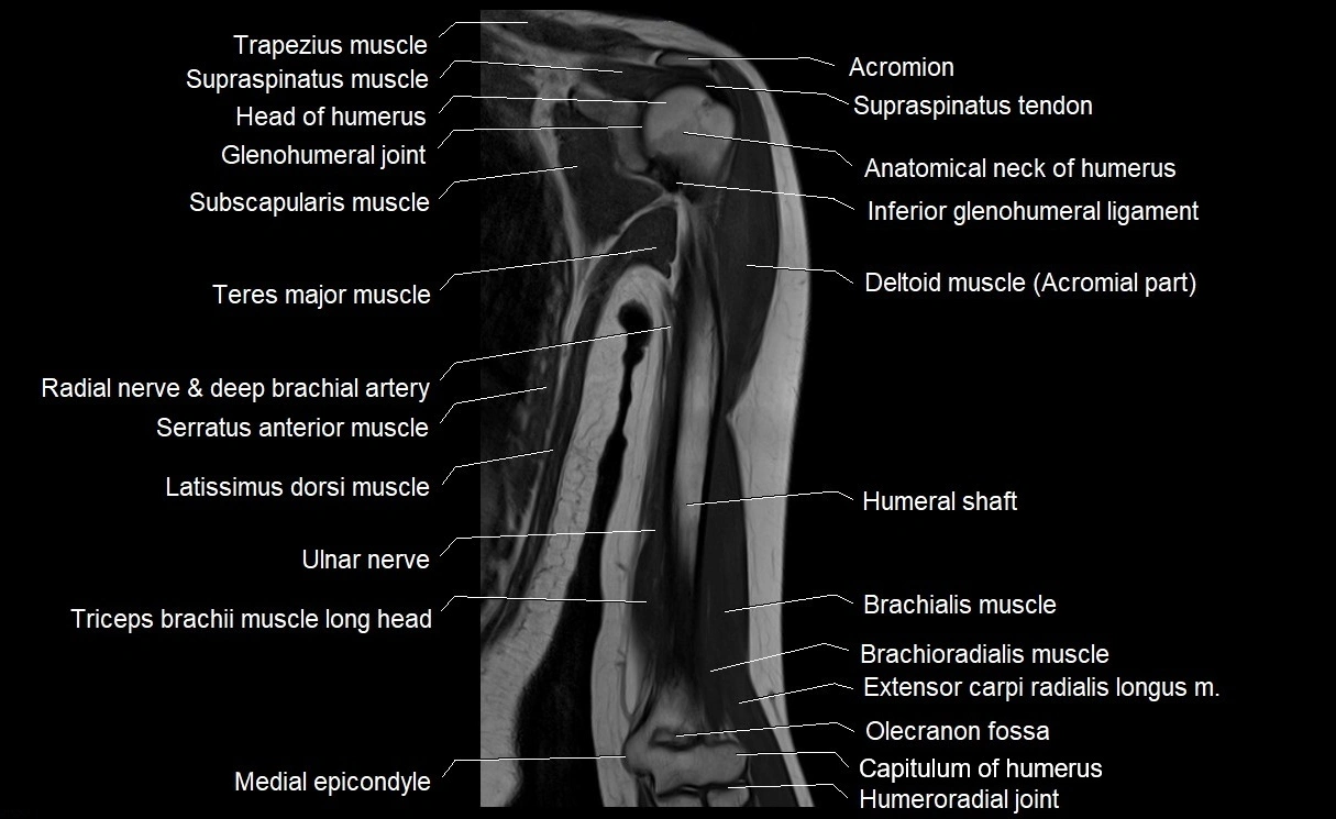 MRI upper arm (humerus ) coronal cross sectional anatomy image 15.webp